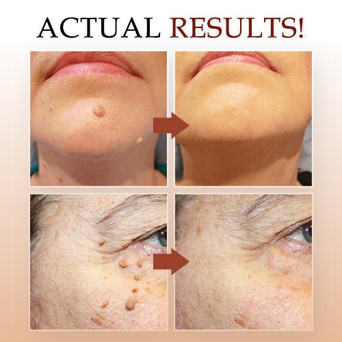 🔥Last Day Promotion 65% OFF🔥𝗤𝗩𝗖 recommends Tags & Moles Remover - beumoonshop