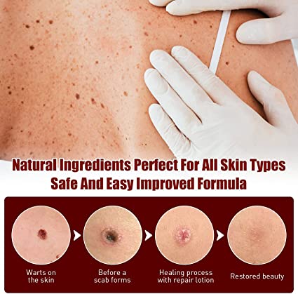 🔥Last Day Promotion 65% OFF🔥𝗤𝗩𝗖 recommends Tags & Moles Remover - beumoonshop
