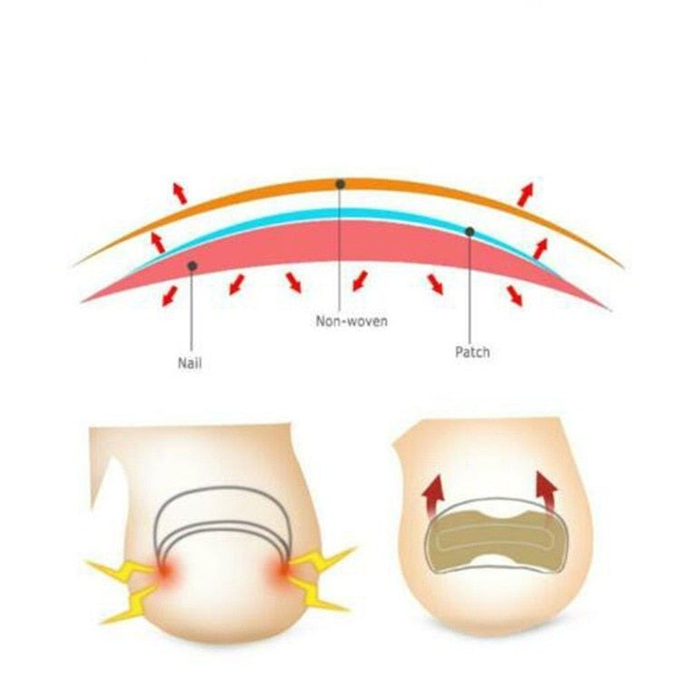 Painless Toenail Patch - ToenailExpress™ - beumoonshop