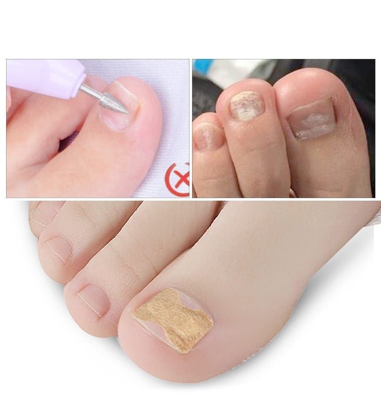 Painless Toenail Patch - ToenailExpress™ - beumoonshop